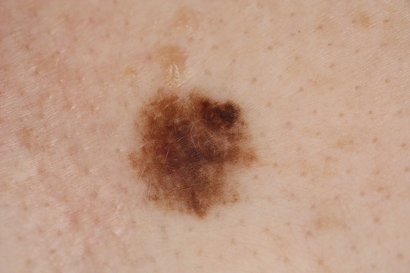 melanoma evolving