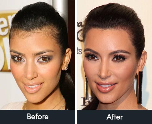 Kim Kardashian Hairline Transformation