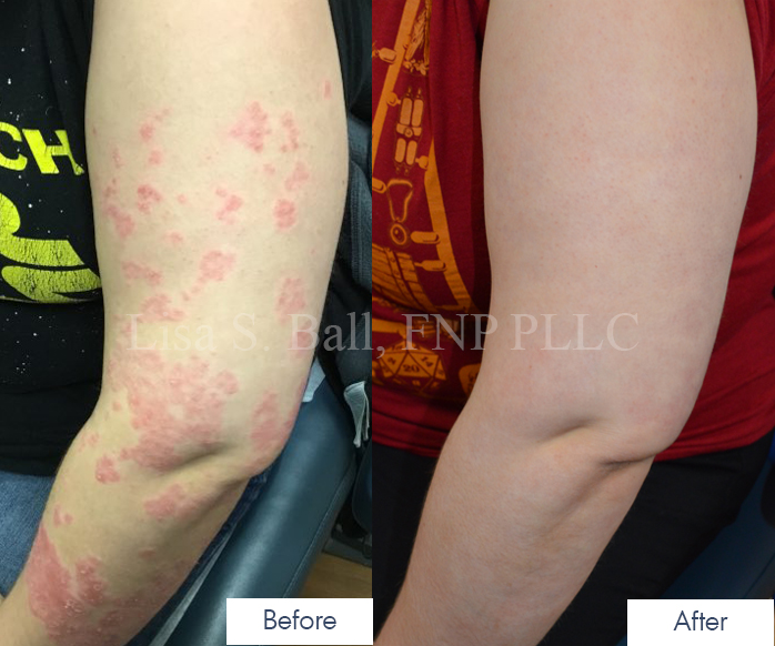 Lisa S. Ball, NP Psoriasis Patient Results