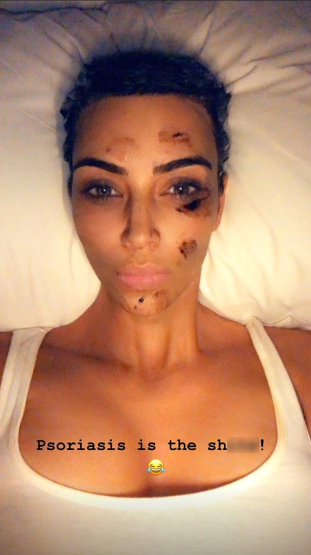 Kim Kardashian Psoriasis Instagram