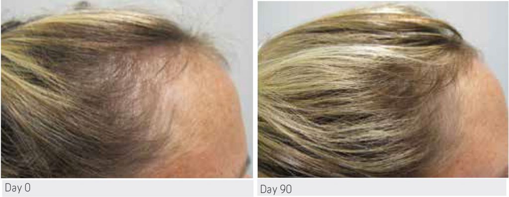 Viviscal Patient Results