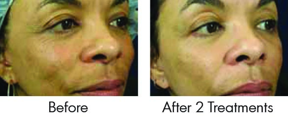 RF Skin Tightening Sublative Patient Results